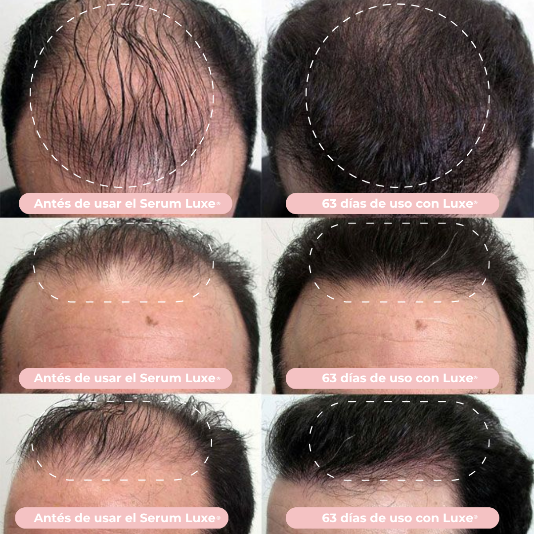Suero de Crecimiento Capilar Luxe® Resultados en 14 días