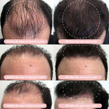 Suero de Crecimiento Capilar Luxe® Resultados en 14 días